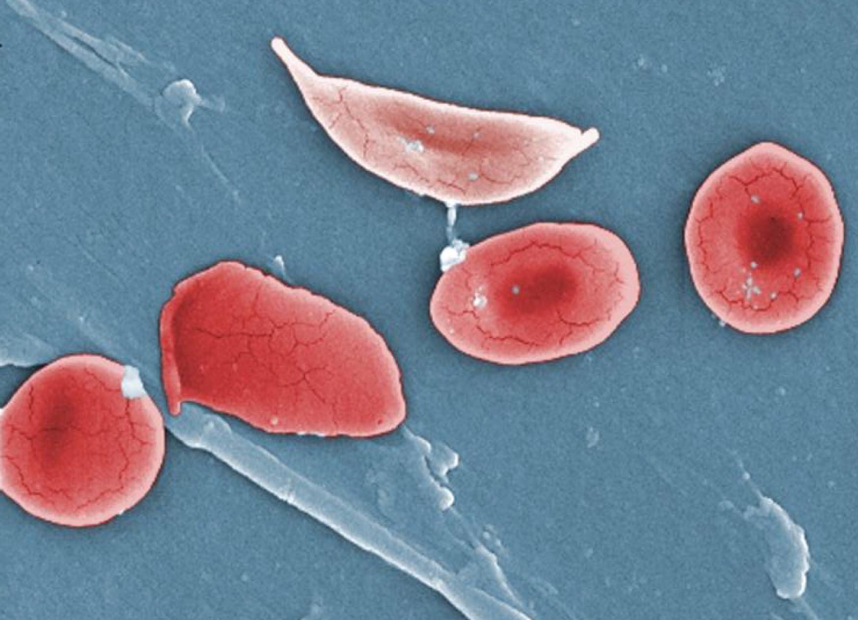 In sickle cell disease, the red blood cells are misshapen and don't carry oxygen well. Image credit - OpenStax College licensed under CC BY 3.0